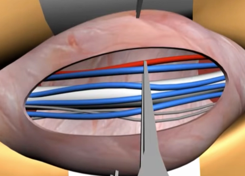 mikroskopik varikosel əməliyyatı