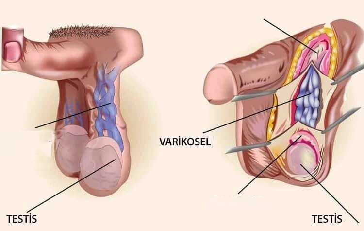 varikosel əməliyyatı