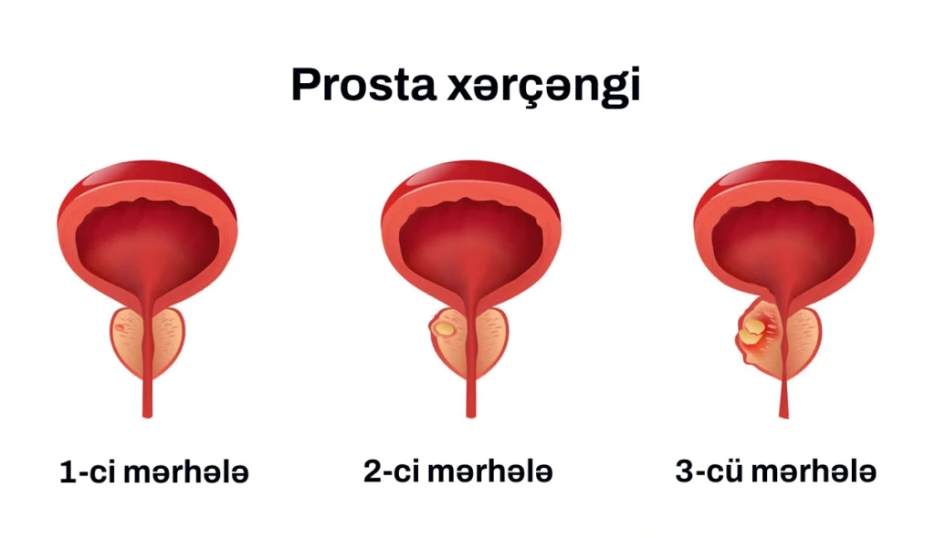 prostat xərçəngi