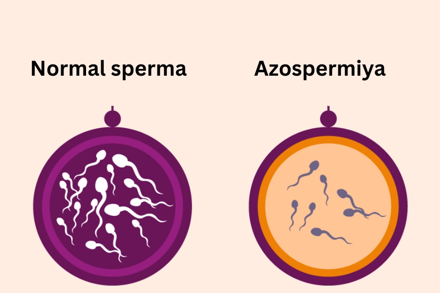 azospermiya kişi sonsuzluğu