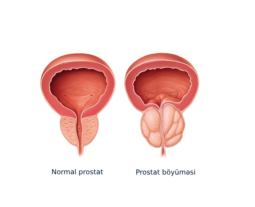 prostat böyüməsi