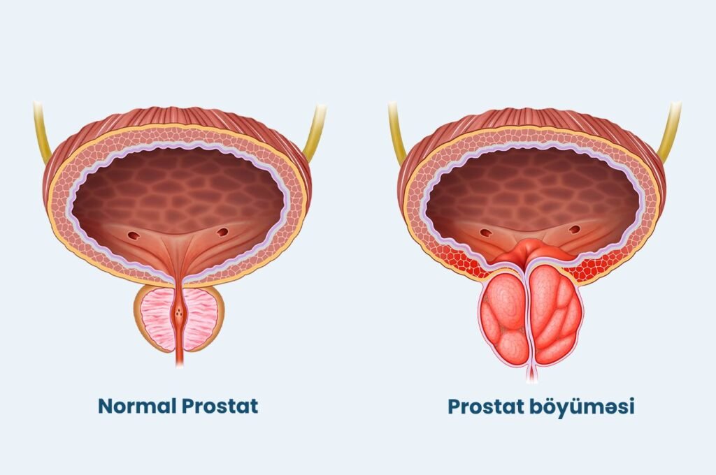 prostat böyüməsi 