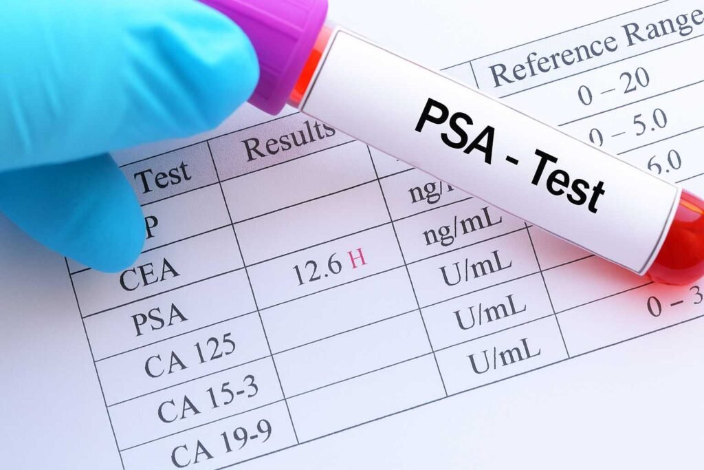 PSA qan testi nə üçün verilir?